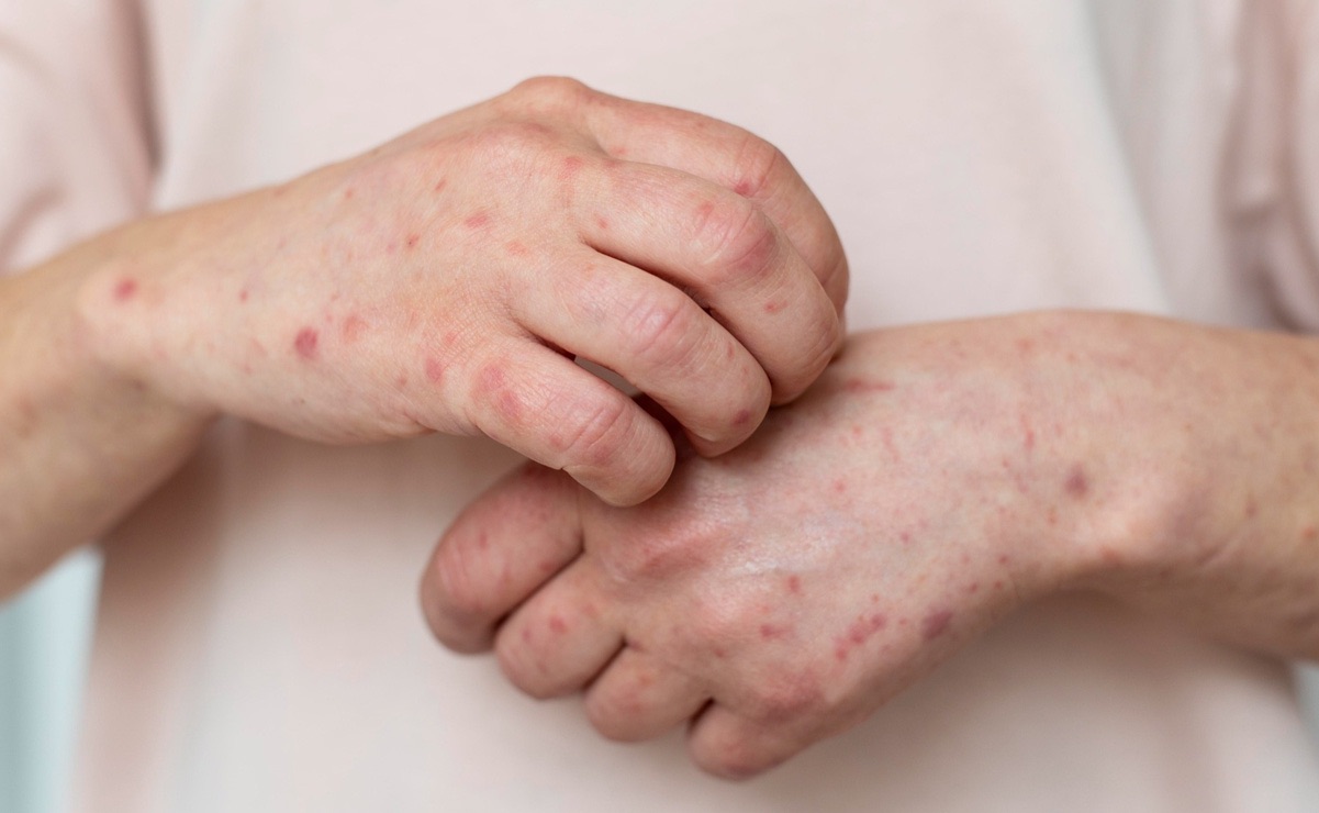 Aumentan casos, pero no hay defunciones por sarampión en Sinaloa