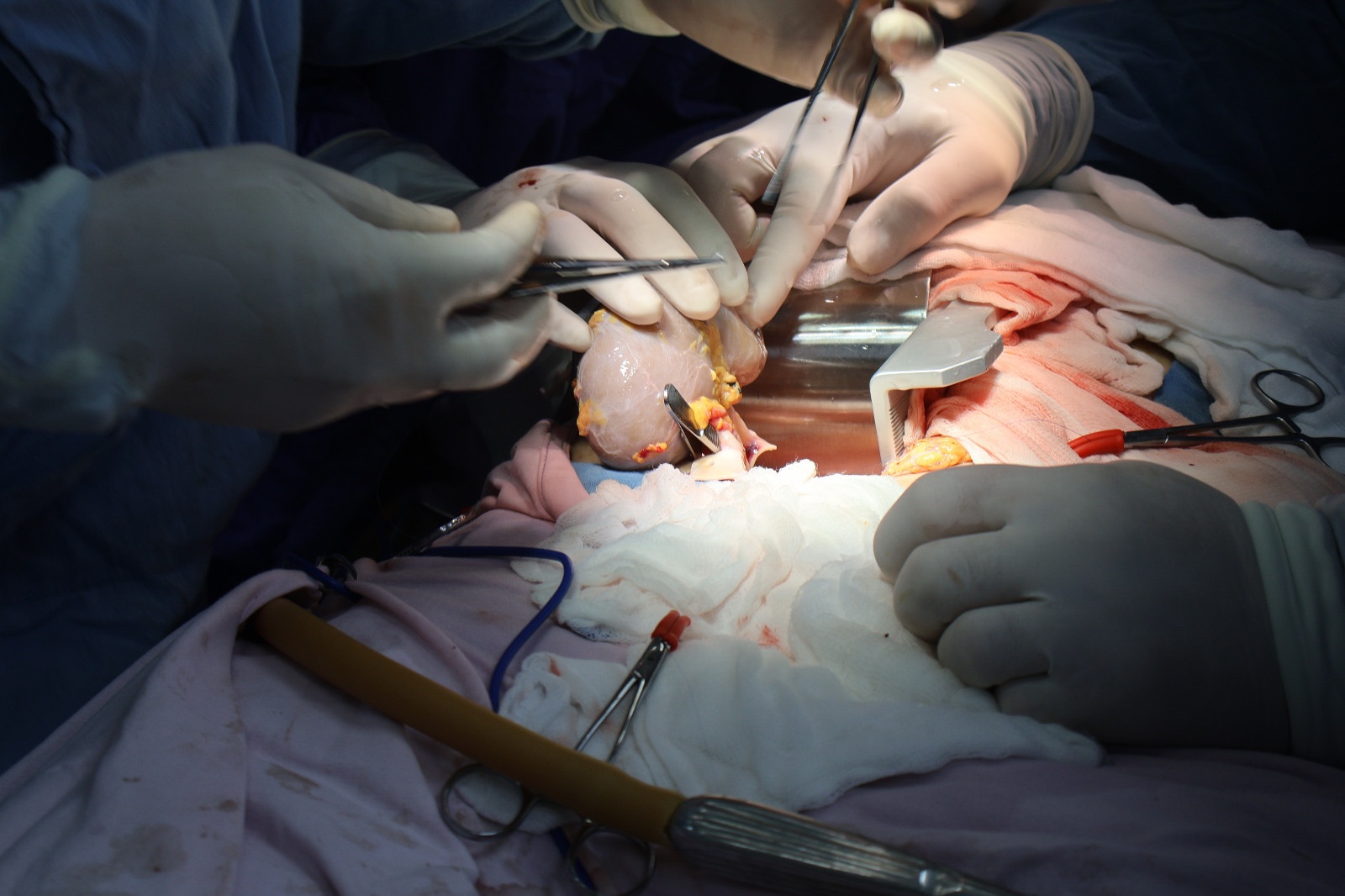 IMSS logra dos trasplantes renales con misión aérea en Sinaloa